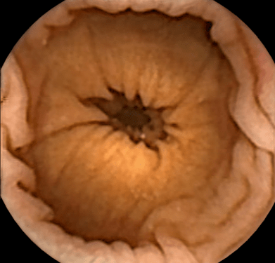 image of the colon acquired by the capsule endoscopy
